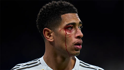 Militao chấn thương, Bellingham đổ máu, Real Madrid khủng hoảng